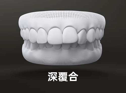 深覆合